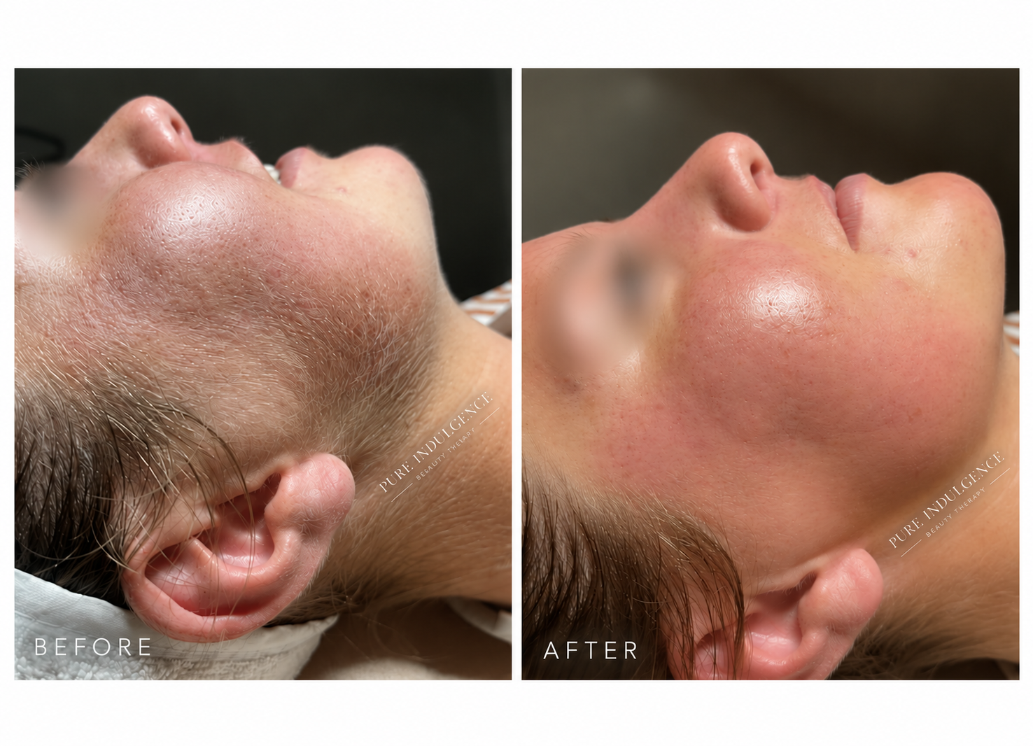 Before and after dermaplaning at Pure Indulgence, showing smoother skin and removal of fine facial hair.